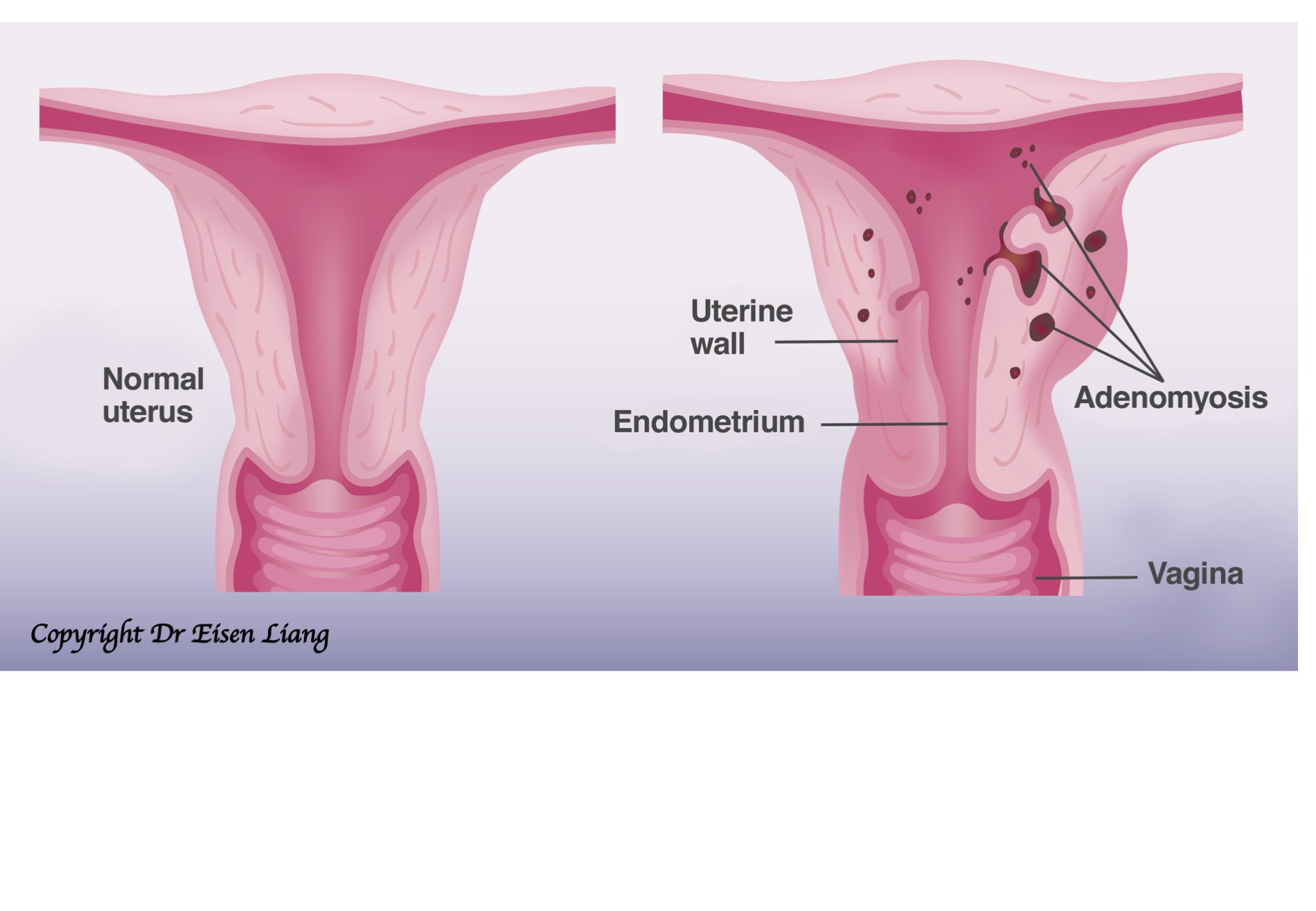 Méhtestrák - EgészségKalauz - Endometrium rák nhs