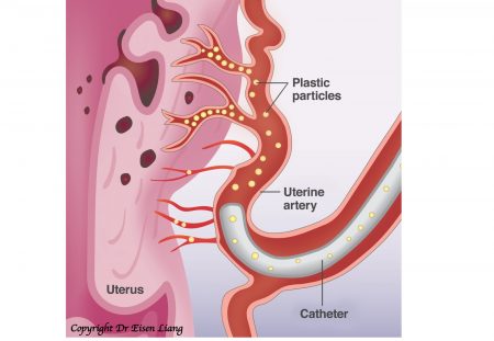 During UAE, small particles are injected to block the blood vessels supplying the uterus.