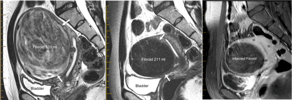 MRI showing fibroid volume went from 533ml to 211ml at six-month progress.