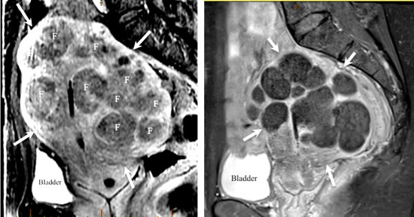 Pre-UFE MRI showed numerous fibroids denoted as F.