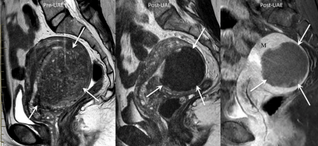 Pre-UAE MRI vs six months post-UAE MRI showed scarring of focal adenomyosis and shrinkage.